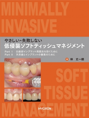 インプラント周囲のティッシュ・マネージメント 【公式通販】