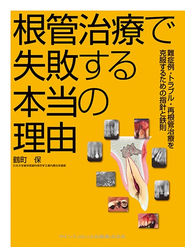 根管治療で失敗する本当の理由 難症例・トラブル・再根管治療を克服