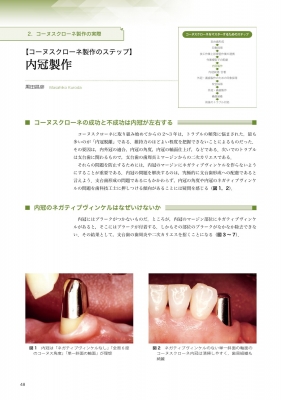 検証コーヌスクローネ : 長期経過症例と臨床統計からの再評価-