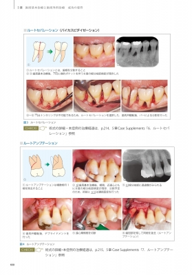 スカンジナビアンアプローチの実践 Dr.弘岡に訊く臨床的ペリオ講座