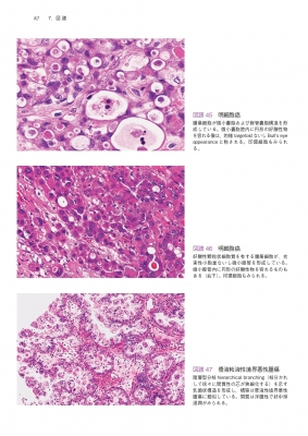 卵巣腫瘍・卵管癌・腹膜癌取扱い規約 病理編 第2版 : 日本産科