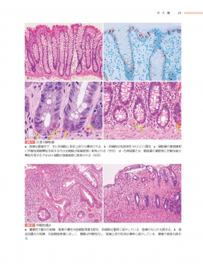 肺 非腫瘍性疾患病理アトラス 通販 (非腫瘍性疾患病理アトラス) |本
