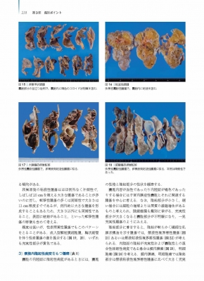 卵巣腫瘍・卵管癌・腹膜癌 腫瘍病理鑑別診断アトラス : 清川貴子