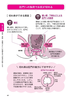 いぼ痔・切れ痔・痔ろう 痔トラブルの治し方 誰にも聞けない悩みをピタッと解消! : 寺田俊明 | HMV&BOOKS online ...