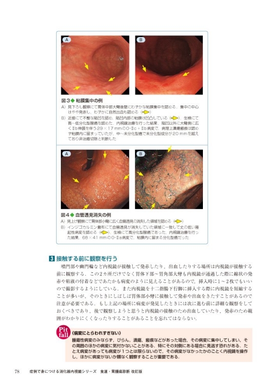 食道・胃腫瘍診断 確実な鑑別・深達度診断のためのコツとCase